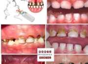 Dream Meaning of Teeth Rotting