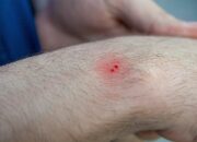 Dream Meaning of Snake Bite On Hand
