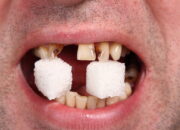 Dream Meaning of Breaking Teeth