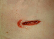 Dream Meaning of Loved One With Stab Wounds