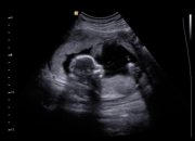Dream Meaning of Ultrasound Pictures