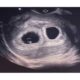 Dream Meaning of Pregnant With Twins After Menopause