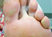 Dream Meaning of Warts On Feet