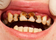 Dream Meaning of Rotten Teeth