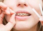 Dream Meaning of Braces Falling Out
