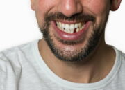 Dream Meaning of My Teeth Falling Out