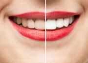 Dream Meaning of Bright White Teeth